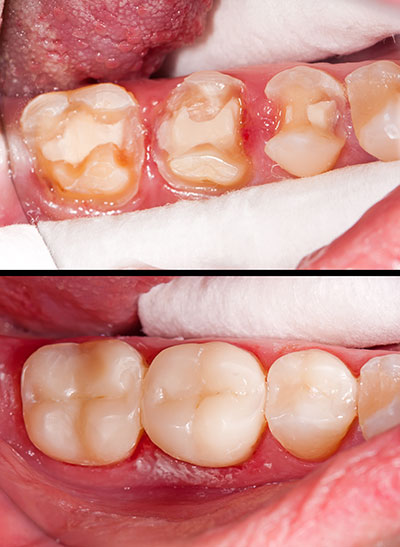 The image shows a close-up view of a person s mouth with teeth that have been severely damaged, likely due to dental decay or other oral health issues. The teeth are discolored and some appear to be missing or broken, with visible signs of decay and staining. There is also an overlay of text on the image, which seems to be a before-and-after comparison, possibly for dental treatment services, highlighting the difference between the damaged teeth in one photo and the repaired teeth in the other.