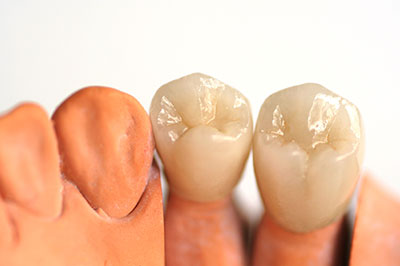 The image shows a set of artificial teeth placed next to each other, with the upper set displaying a full complement of teeth and the lower set showing a partial denture.