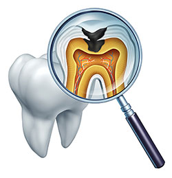 An illustration showing a magnified view of a tooth with an inner structure and a tongue depressor pointing to it.