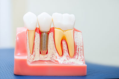 The image shows a model of a human mouth with artificial teeth and gums, featuring a clear plastic toothbrush holder filled with water, positioned in front of a toothbrush.