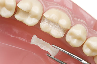 The image shows a dental tray with a partial denture and a small piece of plastic or resin, possibly for repair or customization.