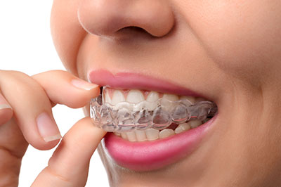 A person wearing a clear braces appliance and holding it with their fingers to their mouth.