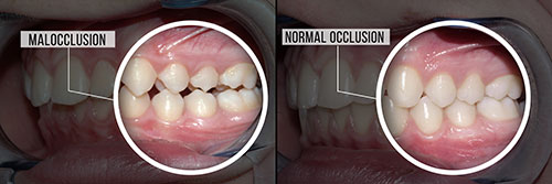 The image shows a before-and-after comparison of a dental treatment, with the  before  side showing a mouth with visible decay and discoloration, and the  after  side displaying a cleaned and whitened set of teeth.