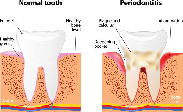 The image is a medical illustration that shows the progression of gum disease from normal to advanced stages, including gingivitis and periodontitis, with annotations indicating bone loss and inflammation.