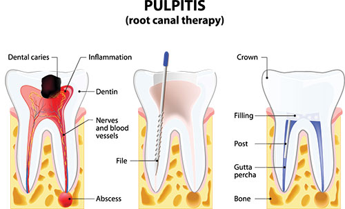 The image is an educational diagram illustrating the process of pulpitis, a dental condition where the pulp of a tooth becomes inflamed. It shows various stages and components of this condition, including the crown, dentin, nerves, and tooth structure with labels such as  root canal therapy,   crown,   dentin,   neural filling,  and  absorb.  The diagram uses color coding to differentiate between the affected areas and the surrounding healthy tissue.