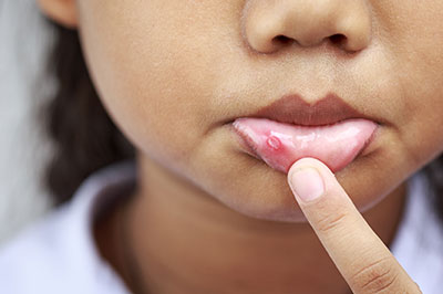 A young girl with a noticeable red spot on her face, possibly an acne or skin condition, is pointing at it with her finger.