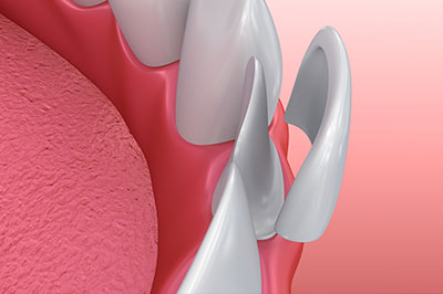 An illustration of a dental implant with a screw-like structure, set against a pink background that represents the gum and a partial view of a human mouth.