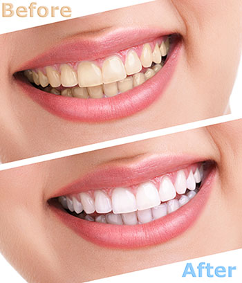 Smiling woman with before and after teeth whitening results.