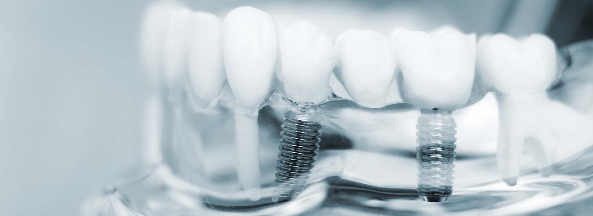 Close-up of a dental implant with screws and abutments, showcasing the intricate components.