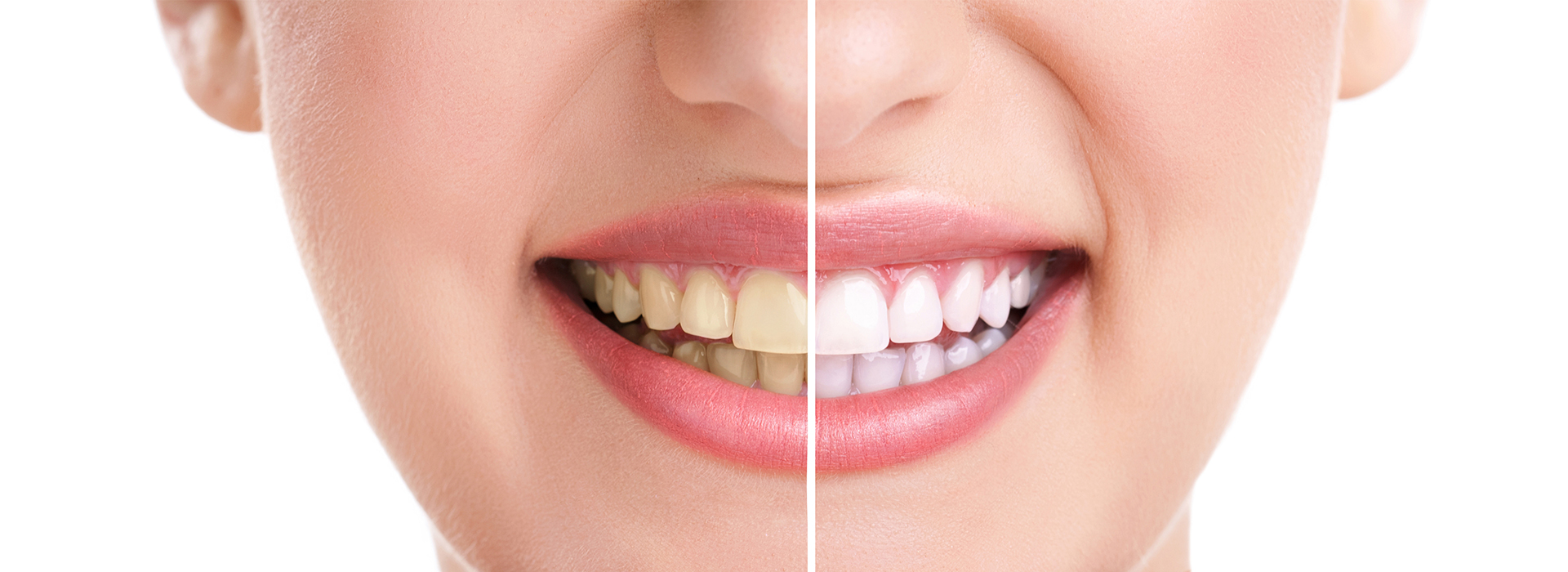 A close-up of a person s smiling face with a focus on their teeth, showcasing a dental treatment result.