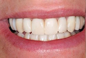 A close-up of a person's smiling mouth with white teeth and pink gums.
