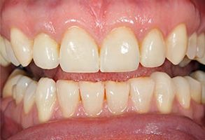 The image shows a close-up of a person's teeth with yellowish stains, indicating the need for dental care.