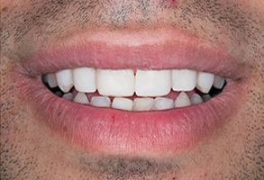 The image shows a close-up of a person's mouth with white teeth, displaying a smile.