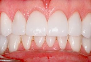 Alt text: Close-up image of a person's teeth with visible staining and yellowing, highlighting the need for dental care.