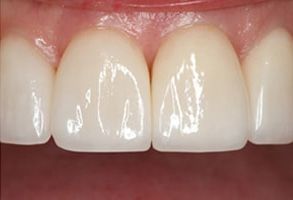 The image displays a close-up view of a person's teeth, showcasing a set of white dental veneers with a natural appearance.