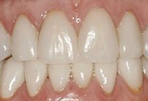 A close-up of a person's teeth showing a dental procedure in progress, with visible tooth enamel damage and repair.