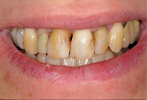 Dental patient with a yellowed smile, showcasing teeth discoloration.