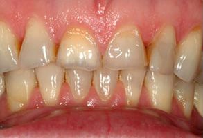 The image shows a close-up of a person's teeth with yellow staining, indicating the need for dental care or treatment.
